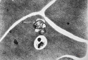 M,30y. | blood - dyserythropoetic anemia M,30y. | blood - dyserythropoetic anemia